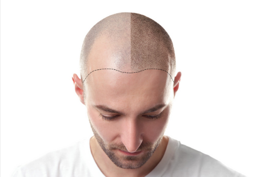What are the common type of hair loss treatment?