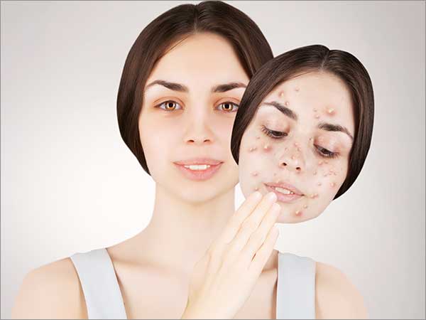 acne treatment in bangalore