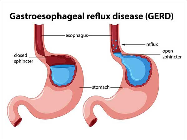 GERD in bangalore