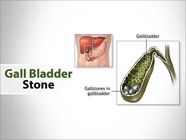 Gall Bladder Stone treatment in bangalore