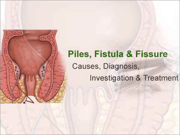 piles, fissure, fistula treatment in bangalore