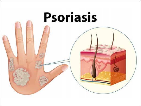 psoriasis treatment bangalore