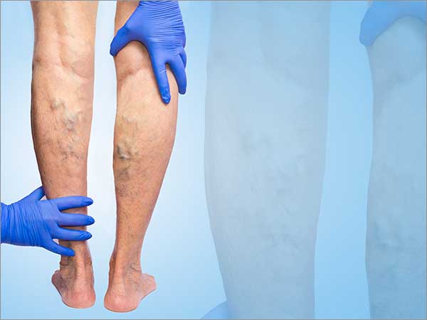 Treatment for Varicose Veins in Bangalore - Symptoms, Causes