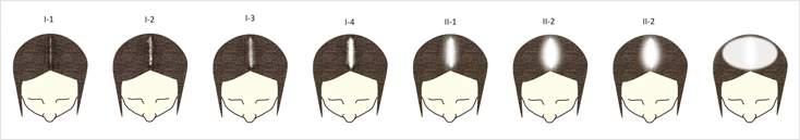 female baldness treatment bangalore