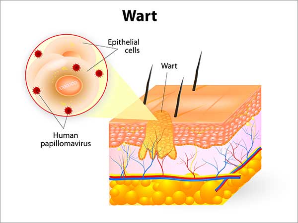 treatment for wart in bangalore